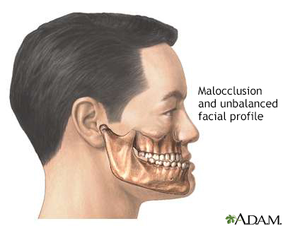 Malocclusion of teeth - Illustration Thumbnail              