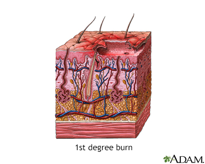 First degree burn - Illustration Thumbnail              