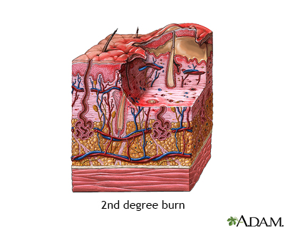 Second degree burn - Illustration Thumbnail              