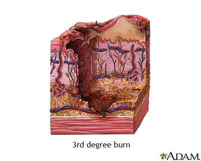 Third degree burn - Illustration Thumbnail              