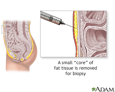 Fat tissue biopsy - Illustration Thumbnail              