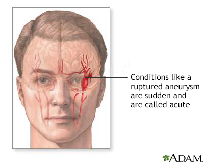 Ruptured intracranial aneurysm - Illustration Thumbnail
                      