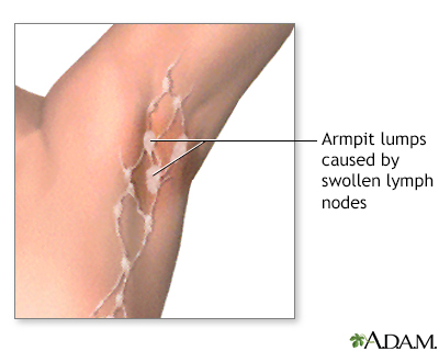 Swollen lymph nodes under arm