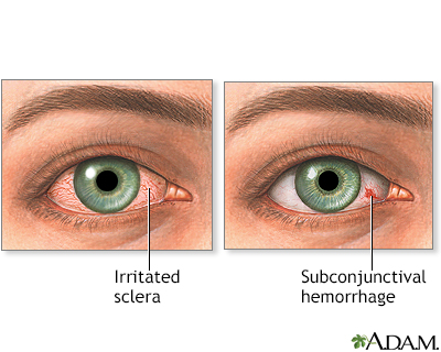 Stearinlys Forskellige Ende Eye redness Information | Mount Sinai - New York
