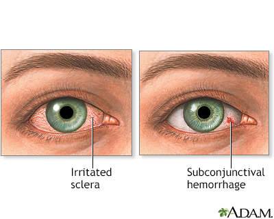 Eye redness Information Mount Sinai New York