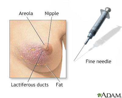 Female breast biopsy - Illustration Thumbnail
              
