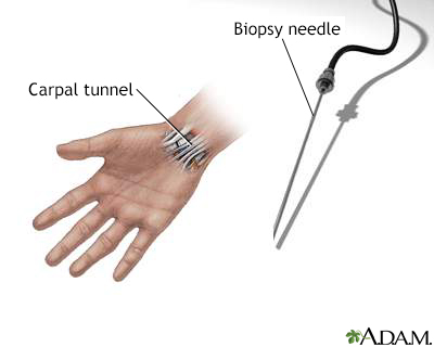 Carpal biopsy - Illustration Thumbnail
                      