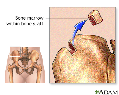 bone marrow transplant pain