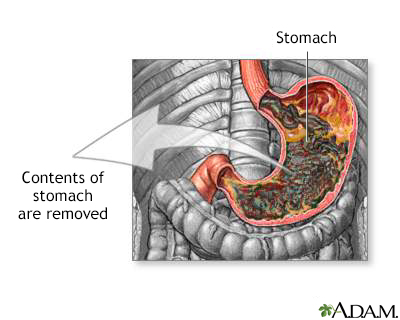 Gastric suction