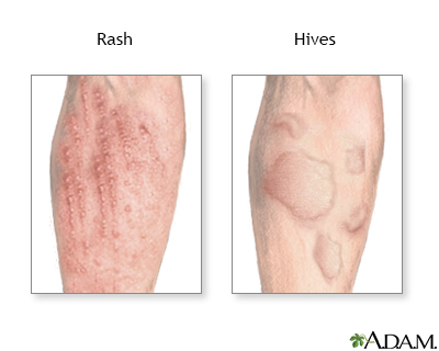 anaphylaxis rash