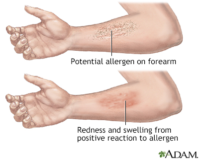 Positive reaction to allergen - Illustration Thumbnail
              