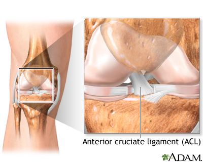 Anterior Cruciate Ligament Tears