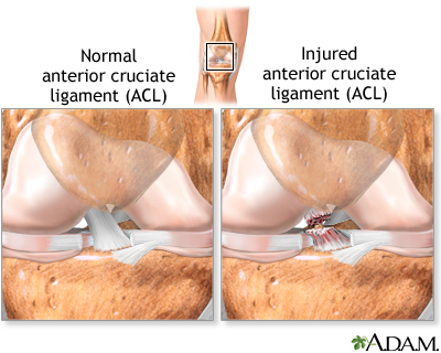 Anterior Cruciate Ligament (ACL) Injuries: What Are They, Female  Predisposition, Signs, Symptoms, and More