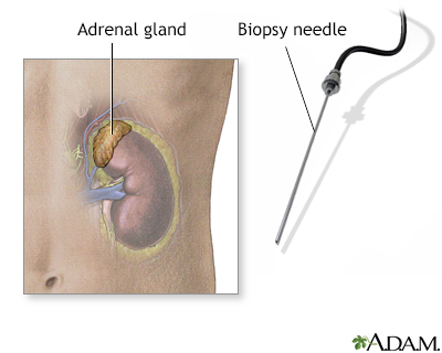 Adrenal gland biopsy - Illustration Thumbnail
              
