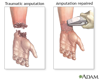 Amputation repair - Illustration Thumbnail
              