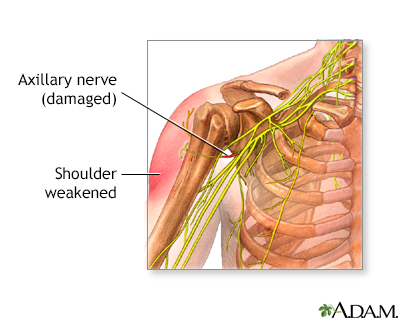 Damaged axillary nerve