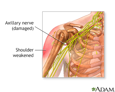 Axillary nerve dysfunction Information