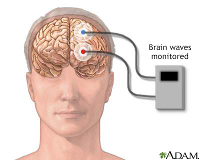 Brainstem Evoked Response Audiometry