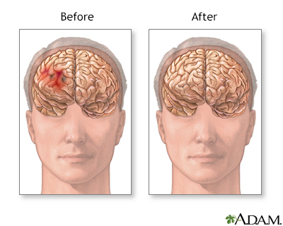 Before and after hematoma repair - Illustration Thumbnail
              