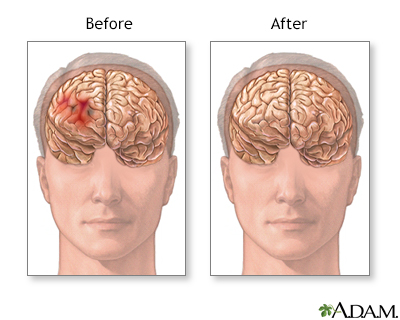 Before and after hematoma repair - Illustration Thumbnail
                      