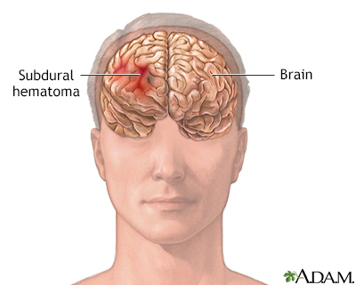 Subdural hematoma - Illustration Thumbnail
              