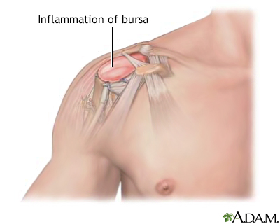 Bursitis of the shoulder - Illustration Thumbnail
                      