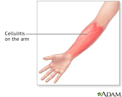 Cellulitis on the arm - Illustration Thumbnail
                      