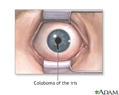 coloboma of the eye