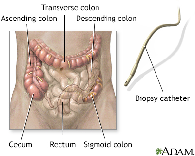 Colonoscopy - Illustration Thumbnail
              