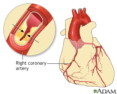 Coronary artery disease - Illustration Thumbnail              