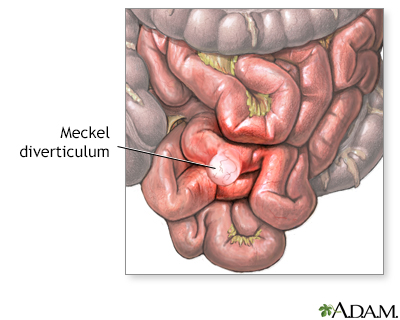 Meckel diverticulum - Illustration Thumbnail
              