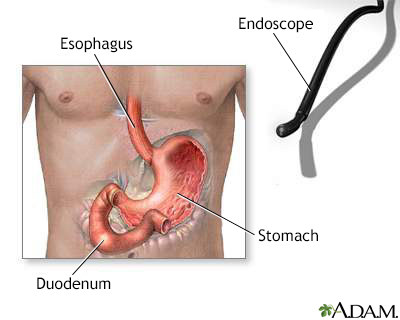 lower endoscopy procedure