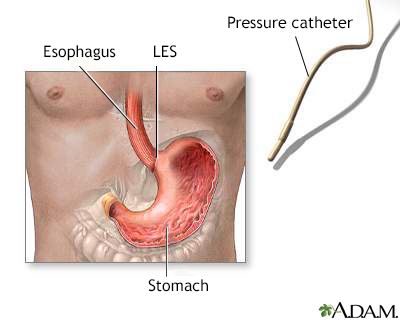 Esophageal manometry