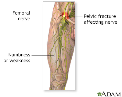 Femoral nerve damage - Illustration Thumbnail
              