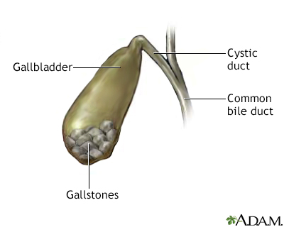 Gallstones - Illustration Thumbnail
                      