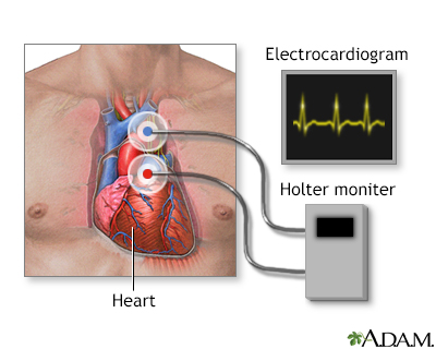Holter heart monitor - Illustration Thumbnail              