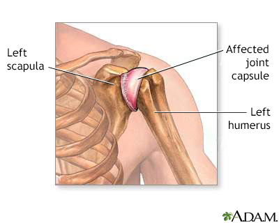 Rotator cuff problems Information