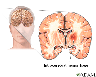 Intracerebral hemorrhage