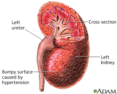 Hypertensive kidney - Illustration Thumbnail
                      