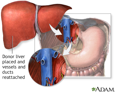 Liver Transplant Information Mount Sinai New York