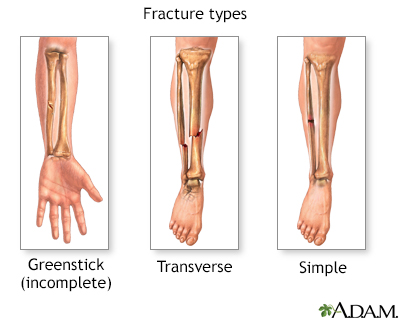 Fracture types (2)