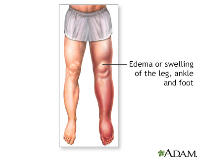 Lower leg edema - Illustration Thumbnail              