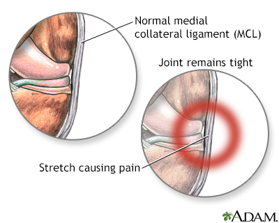 MCL is super tight whenever I stretch.. Is there anything I can do