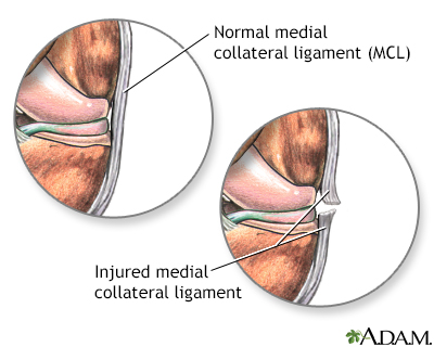 Dealing With & Treating Knee Pain from an MCL Injury
