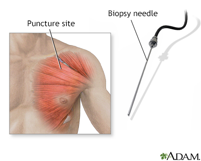 Muscle biopsy - Illustration Thumbnail
              