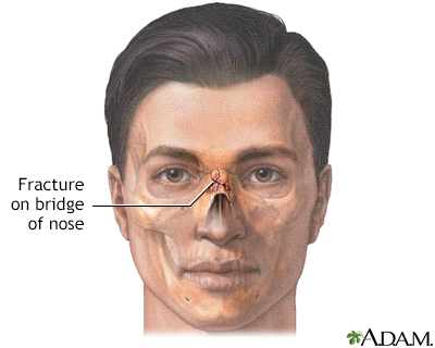 Nose fracture Information Mount Sinai New York