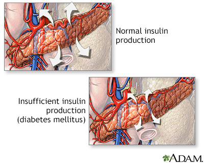 Insulin production and diabetes - Illustration Thumbnail              