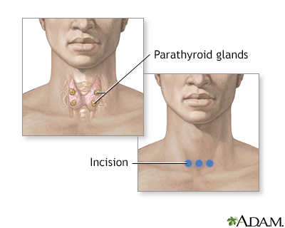 Parathyroid biopsy - Illustration Thumbnail
              