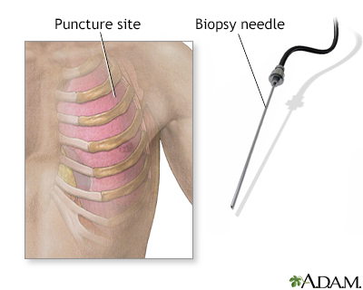 Pleural biopsy - Illustration Thumbnail
              