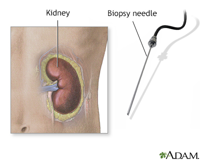 Renal biopsy